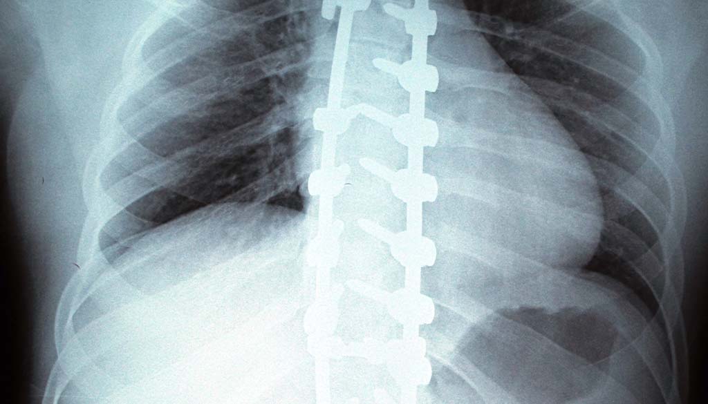 scoliosis